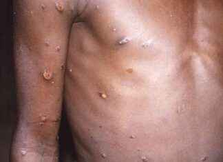 Niveau d’alerte maximum de l’OMS: raisons et implications news-14082024-224726