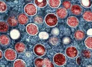 Risque de cas importés en Europe : Premier cas d’infection par le nouveau variant du mpox en Suède news-16082024-065910